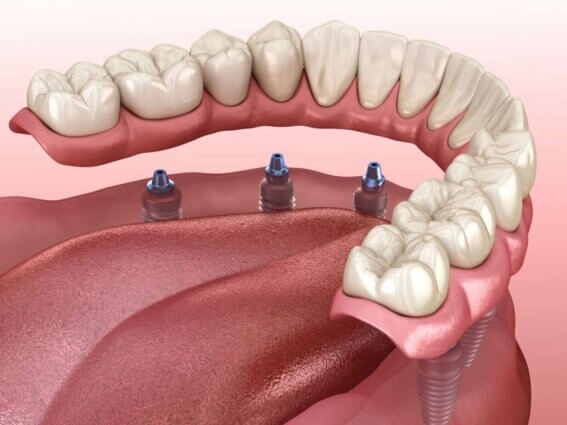 Mandibuläre Prothese mit Kaugummi unterstützt durch Implantate